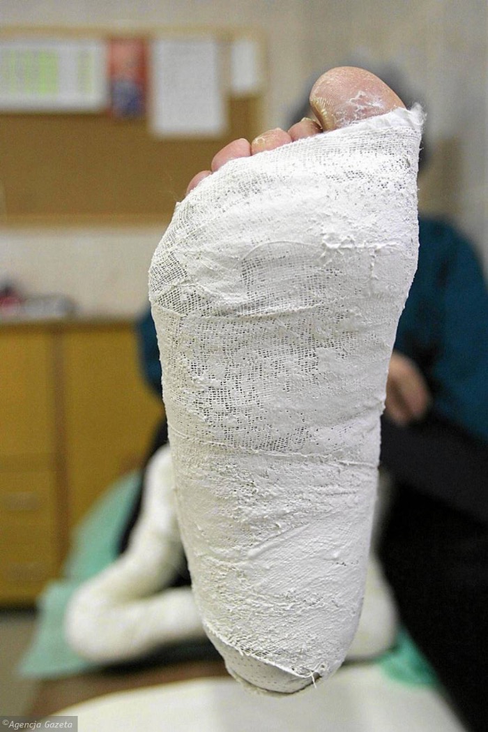 SZPITAL IM. JONSCHERA W ŁODZI ZAPRASZA NA ZABIEGI ENDOPROTEZOPLASYKI STAWU BIODROWEGO I KOLANOWEGO
